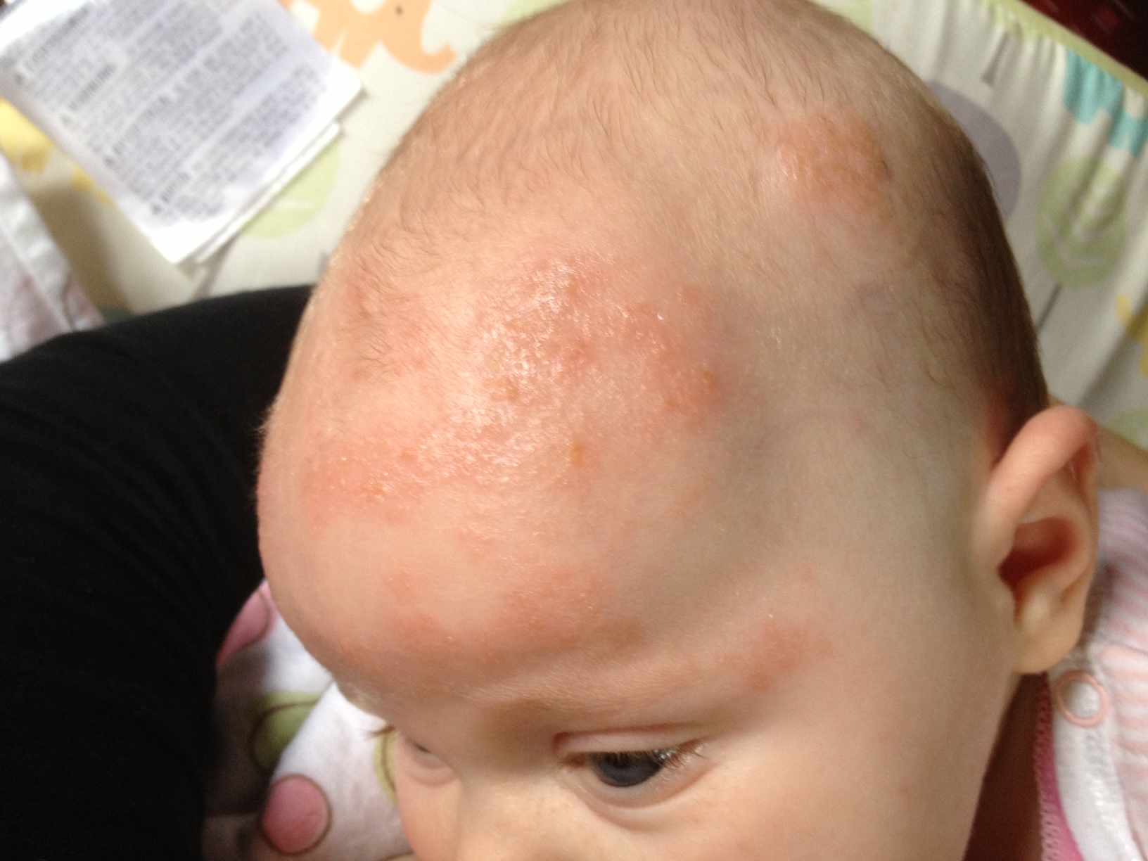 rash on baby forehead #10